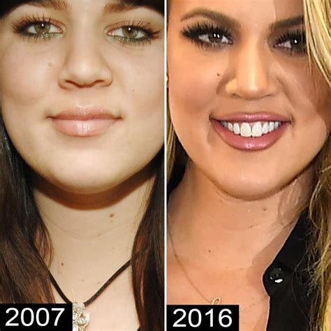 Khloé Kardashian Before and After: See Her Complete Transformation!