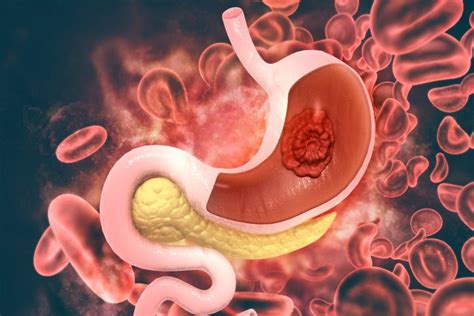 The common signs of stomach cancer that a patient experiences include: Symptoms of Stomach Cancer | Onco.com