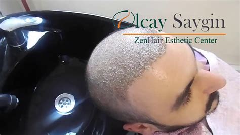 So, how do you remove scabs after a hair transplant? How to do the nine hair wash after hair transplant ...