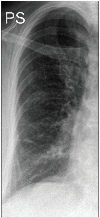 Při zvažování diagnosy plicní embolie posuzujeme vedle klinických projevů přítomnost rizikových faktorů, laboratorní testy, ekg a rtg hrudníku. Nejistý plicní nodulus | proLékaře.cz