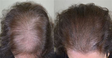 We did not find results for: Scalp Micropigmentation - SMP - Hair Restoration of the ...