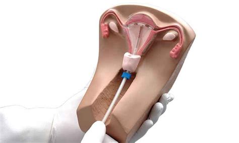 There are two types of iuds: IUD's - Cathedral Medical IUD