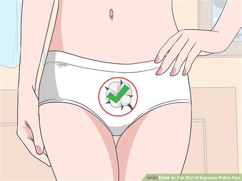 Again, exfoliating gets rid of dead skin cells, making it harder for hairs to get trapped under the skin. How to Get Rid of Ingrown Pubic Hair: 15 Steps (with Pictures)