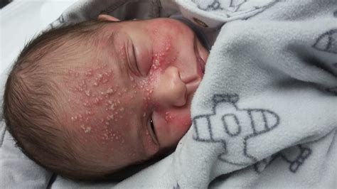 Both cause sores along with a few other symptoms. What You Must Know About Herpes Simplex Infection And ...