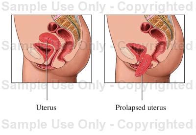 Rahim jatuh dan masuk sehingga ke bahagian bawah faraj dan pangkal rahim dapat dilihat sedikit pada pintu faraj. NIEYA PENGEDAR JAMU SUSUK DARA: PUNCA-PUNCA Peranakan atau ...