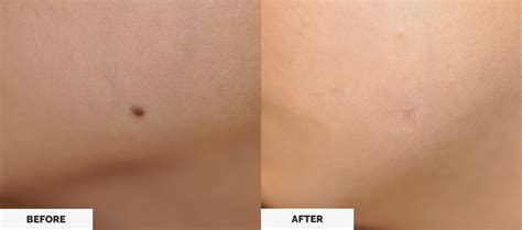 1233 x 687 jpeg 92 кб. Treatment or Removal of Moles, Cysts, and Lipomas | Vivida Dermatology