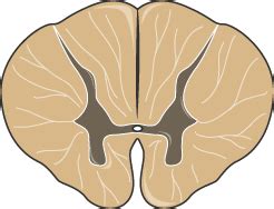This can cause pain, muscle weakness, paralysis, sensory problems, or bladder and bowel dysfunction. Transverse Myelitis | Action Potential Rehabilitation