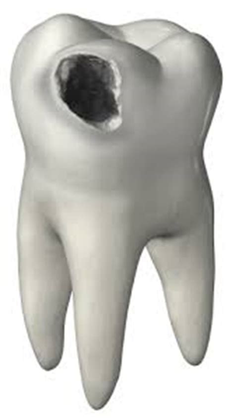 Maybe you would like to learn more about one of these? Having a Tooth Hole Without Any Pain: Why and How to Treat ...