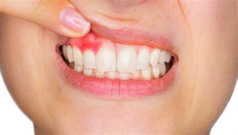 Banyak diantara kita yang baru mengalami gusi belakang bengkak karena si gigi bungsu baru muncul pada usia dewasa lanjut. Cara Mengobati Gusi Bengkak - inilahtasik.com