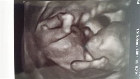 You and an opponent are left.you get shot in the face,but did a lot of damage to the opponent,almost killing him. 12w5d NT scan with 3D pics, Guesses? - BabyCenter