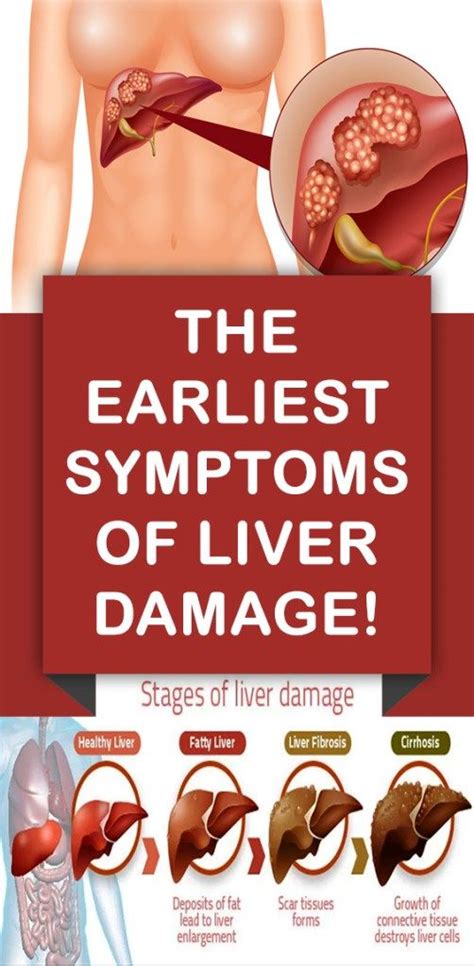 The Earliest Symptoms Of Liver Damage! | Liver failure symptoms, Liver ...