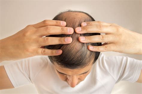 Short combover with temple fade. Early Signs of Balding in Men and Women