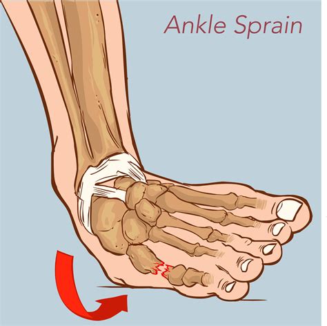 Pain or tenderness along the lateral ankle esp at the atfl. Sprained Ankle Product Tag Archives · Dunbar Medical
