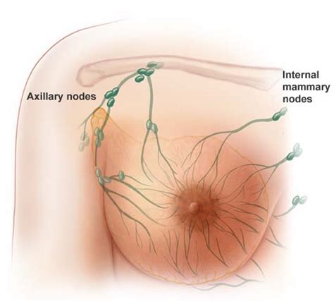 See your doctor promptly if you have breast symptoms that look like inflammation. breast cancer example | Medical Pictures Info - Health ...