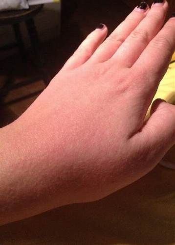 Токсикодермия лечение и диета Токсикодермия(токсидермия): чем вызывается, классификация, диета и лечение Токсикодермия(токсидермия): чем вызывается, классификация, диета и лечение Токсикодермия лечение и диета