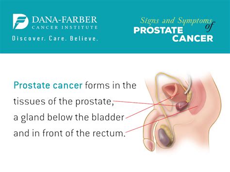 Men may also notice that they have difficulty starting to urinate as well as a decreased when prostate cancer spreads, the bones are the most common site of metastases. What Are The Symptoms of Prostate Cancer? | Dana-Farber ...