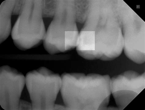 Eine weiterentwicklung der initialkaries kann durch die behandlung von karies bzw. dentinadhäsive Kompositrestauration | Zahnnotizen