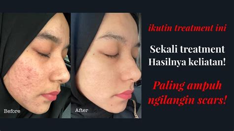 Terakhir, kamu bisa melakukan medical treatment bernama dermal filler untuk mengatasi bopeng jenis boxcar scar. Treatment PRP, Laser CO2 & Dermapen yang manakah paling ...