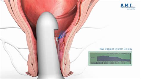 Eine hämorrhoiden op ist in einigen fällen leider notwendig, insbesondere wenn es sich um die. Hemoroizii trombozati - tratament | Scapa de hemoroizi