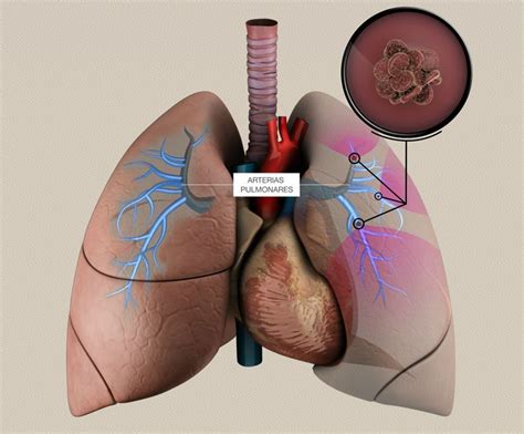 When a blood vessel (a vein or an artery) is injured, the body uses platelets. Toda la información sobre la embolia pulmonar - TROMBO.info