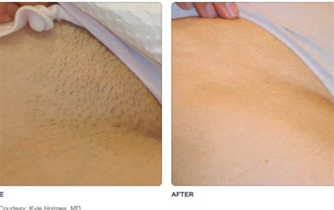 Laser hair removal is most effective on hair that is dark and coarse against fair skin. Laser hair removal bikini provided by professional ...