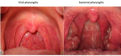 A sore throat may feel worse when you if your sore throat is cause by the flu, your doctor may prescribe antiviral medicine. Sore throat: Causes, Symptoms and Health measures