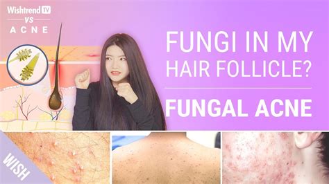 It is especially worse on hot summer 4. Fungal Acne SAFE Skincare Routine l That Acne Never Goes ...