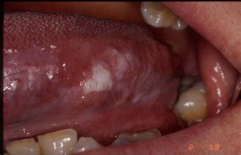 Oral leukoplakia (ol) is a white patch or plaque of the oral mucosa that cannot be characterised clinically or pathologically as any other condition such as cheek biting, candidosis, lichen planus and. Dentistry lectures for MFDS/MJDF/NBDE/ORE: Leukoplakia ...