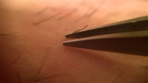 If treated properly, you can get rid of ingrown hairs in your pubic region at home, but if pus, bleeding or other signs of infection occur, you should seek medical help. Trich Pluck & Pull hair with tweezers MACRO video w ...