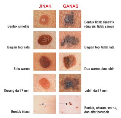 Simak ulasan lengkap mengenai kanker hidung dalam artikel finansialku berikut ini. Obat Kanker Kulit Herbal | Obat Kanker Darah