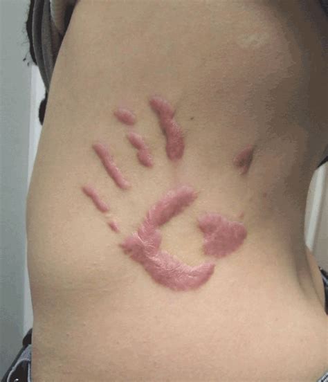 Tattoos, piercing, and scarification are now commonplace among adolescents and young adults. Metaphor of Difference: Scarification