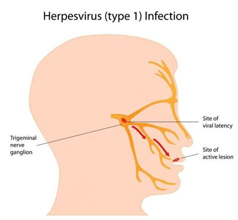 It comes in two flavors: Herpes Simplex Virus: HSV-1 and HSV-2 | NPC