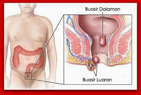 Apakah yang dimaksudkan dengan buasir? Petua-Petua Harga Ubat buasir Ambejoss Anyar Di farmasi ...