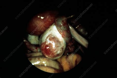 Take control of your fertility with mira fertility. Ovulation - Stock Image - P616/0328 - Science Photo Library