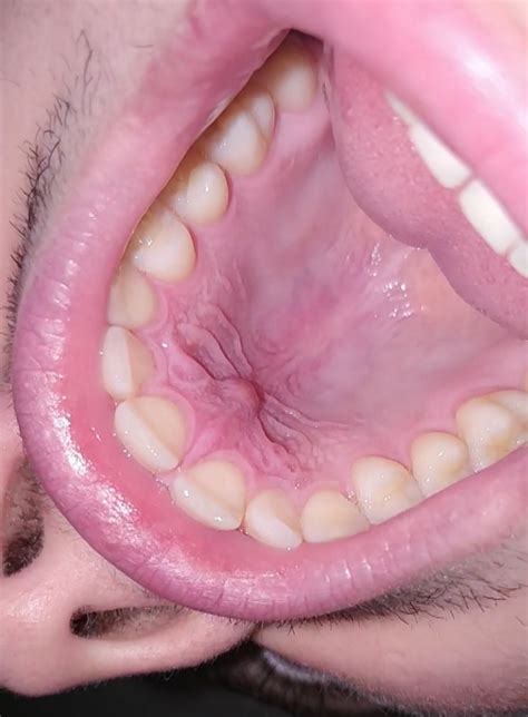 This condition can include the tiny purple spots on the skin's surface. Help! I have a bump on the roof of my mouth behind my front teeth. It hurts and causes ...