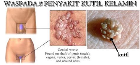 Kudis buta ialah keadaan kegatalan pada kulit yang disebabkan oleh gigitan kutu yang bernama sarcoptes scabiei. Obat Kadas Kudis Kurap Ampuh: Obat Kutil Kelamin Tanpa ...