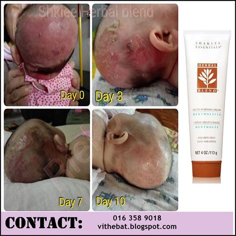 Panduan cara menghilangkan kutu rambut secara cepat dan ampuh dengan menggunakan obat berbahan alami yang mudah dibuat di rumah secara tradisional. Badan Sihat Hati Ceria: Cara Hilangkan Ruam di Muka dan ...