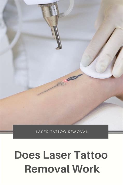 As the procedure proceeds, you see how progressively lighter the tattoo looks. Does Laser Tattoo Removal Work? | Dubai Cosmetic Surgery ...