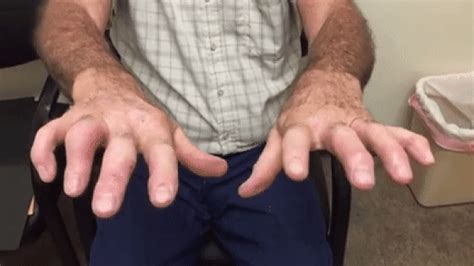 May 20, 2014 · someone with a severe tremor can have their hands shaking uncontrollably. How the PARK2 Gene Causes Early-Onset and Juvenile ...
