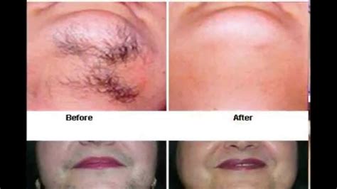 See the benefits of electrolysis and laser hair removal. Miami Hair Removal - Before and After Pictures - YouTube