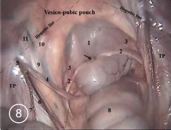 The medial umbilical ligaments are particularly easy to see in laparoscopy and represent an important anatomic landmark for. Laparoscopic Anatomy of the Abdomen in Dorsal Recumbent ...