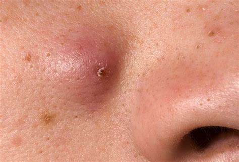 Nodular acne and cystic acne. Acne Visual Dictionary | Pimples under the skin, Nodule ...