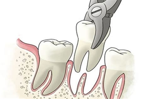 Got my wisdom teeth removed about 2 hours ago, multiple tldrs of the stuff that happened if you're curious how yours might go. Tooth Extraction and Surgery in Indore - Teeth & Braces Clinic