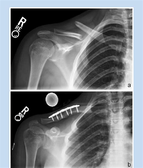 Middle third diaphyseal clavicle fracture with skin ...