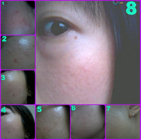 Before using t3 pimple gel, inform your doctor about your current list of medications, over the counter products (e.g. GREAT SKIN&LIFE: REVIEW ON HOE T3 MYCIN CLINDAMYCIN GEL 1%