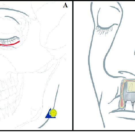 Check spelling or type a new query. Weber Ferguson approach, to access maxillary tumor ...