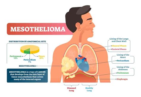 Survival of lactic acid bacteria in the human stomach and probiotics reduce symptoms of antibiotic use in a hospital setting: Malignant Mesothelioma- Causes, treatments, and life ...