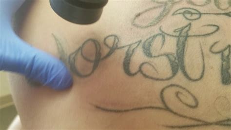 Started in 2013, we have the best results in the industry and are the largest laser tattoo removal company on the east coast. Safe & Gentle TATTOO REMOVAL - BEST EXPERIENCE - YouTube