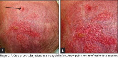 You can get a rash from poison ivy any time of the year. Figure 2 from Diagnostic dilemmas of a herpes-like rash in ...