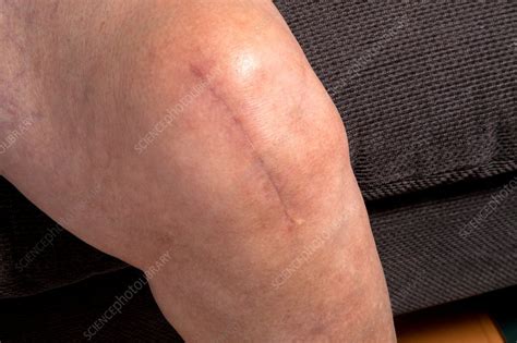 Total knee replacement surgery is a complex operation. Three month old Post Operative Scar - Stock Image - C014 ...